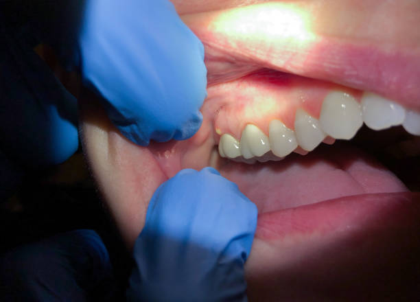 Best Emergency Treatment for Dental Infections or Abscesses in Carnot Moon, PA
